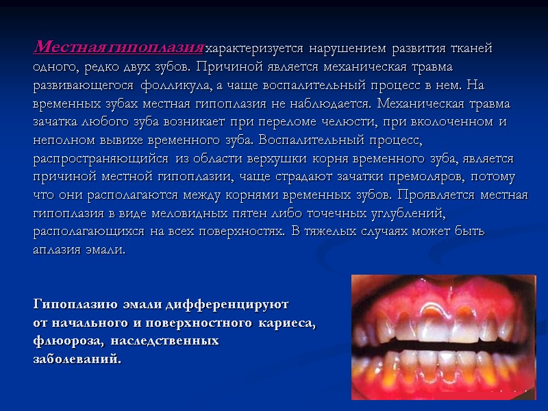 Местная гипоплазия характеризуется нарушением развития тканей одного, редко двух зубов. Причиной является механическая травма